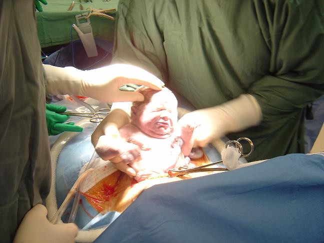 Dr Serag Youssif Caesarean Section 3