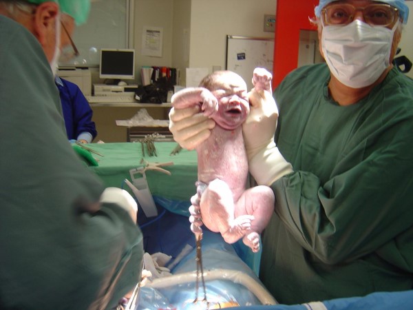 Dr Serag Youssif Caesarean Section 5